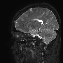 Cerebral arteriovenous malformation at posterior body of corpus callosum (Radiopaedia 74111-84925 Sagittal T2 47).jpg