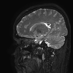 Cerebral arteriovenous malformation at posterior body of corpus callosum (Radiopaedia 74111-84925 Sagittal T2 86).jpg