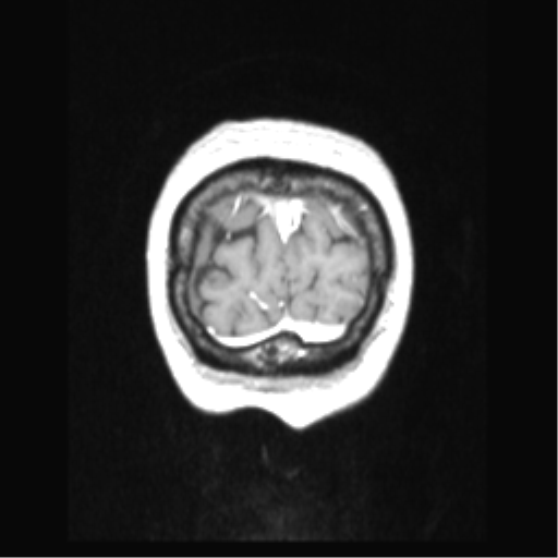 Cerebral arteriovenous malformation with hemorrhage (Radiopaedia 34422-35737 Coronal T1 C+ 9).png