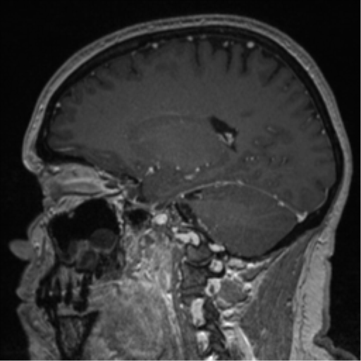 File:Cerebral cavernoma and development venous anomaly (Radiopaedia 37603-39482 Sagittal T1 C+ 59).png