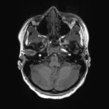 Cerebral cavernous venous malformation (Radiopaedia 70008-80021 Axial T1 13).jpg