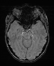 Cerebral cavernous venous malformation (Radiopaedia 70008-80021 I 27).jpg