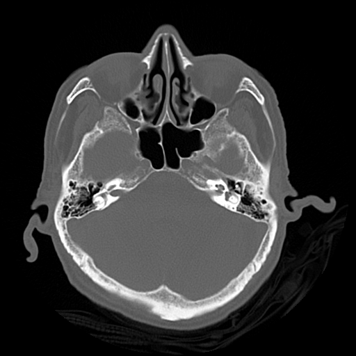 Cerebral contusions, subarachnoid hemorrhage and subdural hygromas (Radiopaedia 55399-61827 Axial bone window 14).png