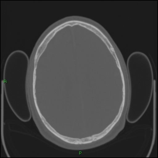 Cerebral contusions (Radiopaedia 33868-35039 Axial bone window 144).jpg