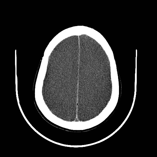 Cerebral edema (evolution in time) (Radiopaedia 19418-19439 non-contrast 70).jpg