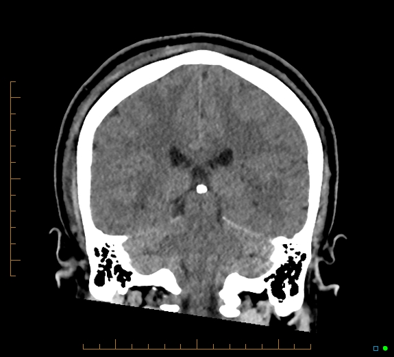 Cerebral fat embolism (Radiopaedia 85521-101224 Coronal non-contrast 40).jpg