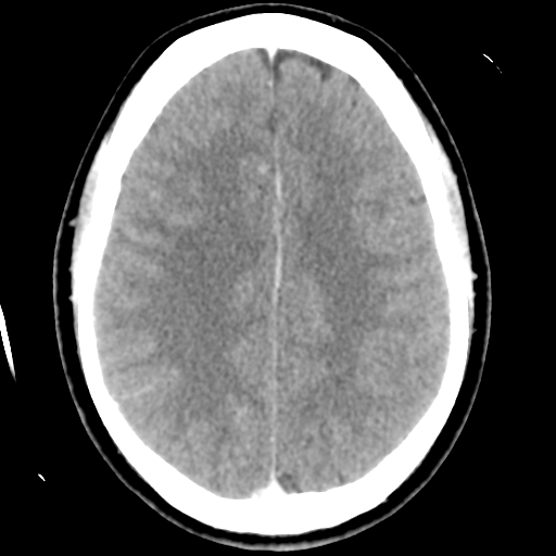 Cerebral hemorrhage secondary to arteriovenous malformation (Radiopaedia 33497-34561 B 37).png