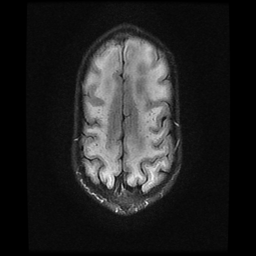File:Cerebral manifestations of mucopolysaccharidosis type I (Radiopaedia 59171-66487 Axial FLAIR 18).jpg