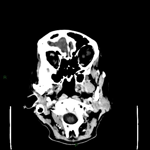 File:Cerebral metastases - breast primary (Radiopaedia 77653-89857 Axial C+ delayed 13).jpg