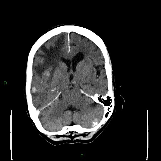 Cerebral metastases - breast primary (Radiopaedia 77653-89857 Axial C+ delayed 47).jpg