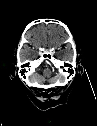 File:Cerebral metastases - ependymal and parenchymal (Radiopaedia 79877-93131 Axial C+ delayed 16).jpg