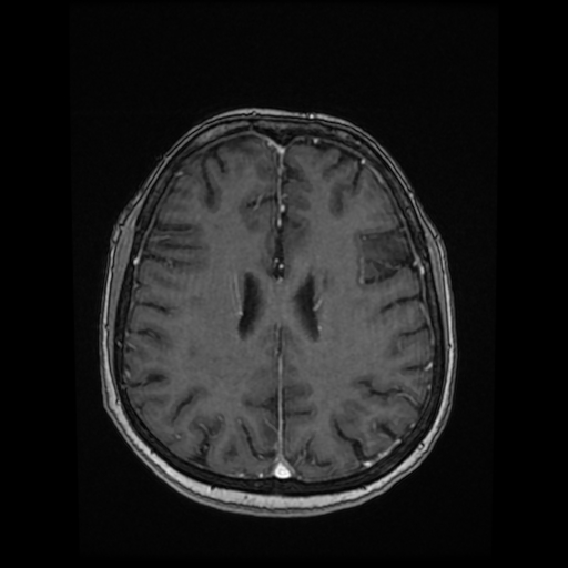 Cerebral metastases - melanoma (Radiopaedia 80972-94522 Axial T1 C+ 65).jpg