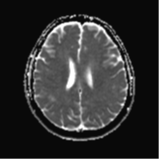 File:Cerebral metastases mimicking abscesses (Radiopaedia 45841-50131 Axial ADC 19).png