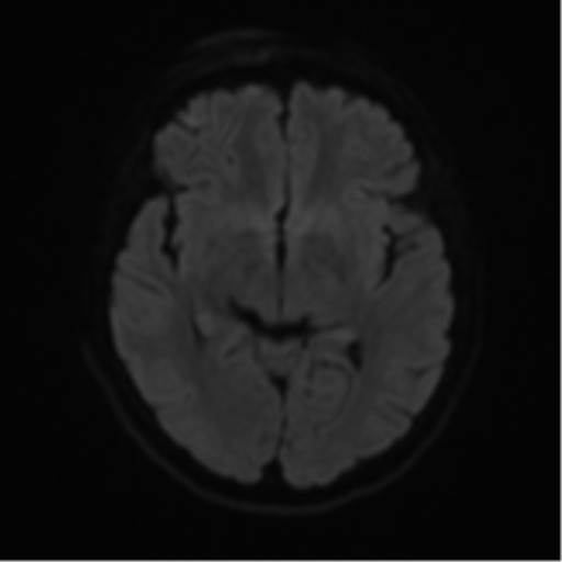 Cerebral metastases mimicking abscesses (Radiopaedia 45841-50131 Axial DWI 42).png