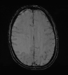File:Cerebral metastasis - melanoma (Radiopaedia 54718-60954 Axial SWI 39).png