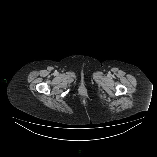 Cerebral metastasis from renal cell carcinoma (Radiopaedia 82306-96378 A 215).jpg