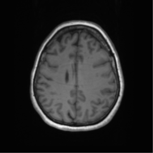 Cerebral metastasis mimicking glioblastoma (Radiopaedia 69155-78937 Axial T1 48).png