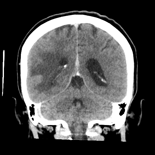 Cerebral metastasis to basal ganglia (Radiopaedia 81568-95412 Coronal C+ delayed 42).png