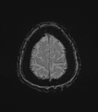 Cerebral metastasis to basal ganglia (Radiopaedia 81568-95413 Axial SWI 80).png