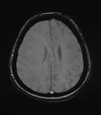 Cerebral metastasis to basal ganglia (Radiopaedia 81568-95413 Axial SWI magnitude 63).png