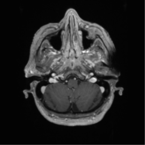 Cerebral metastasis to basal ganglia (Radiopaedia 81568-95413 Axial T1 C+ 11).png