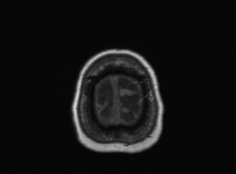 Cerebral ring enhancing lesions - cerebral metastases (Radiopaedia 44922-48817 Axial T1 107).jpg