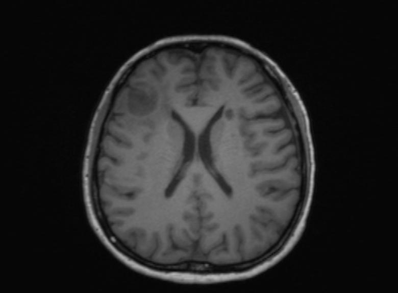 Cerebral ring enhancing lesions - cerebral metastases (Radiopaedia 44922-48817 Axial T1 200).jpg