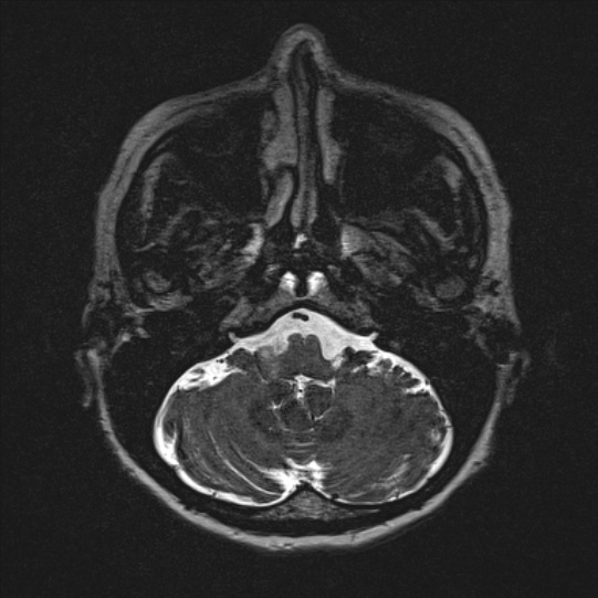 Cerebral ring enhancing lesions - cerebral metastases (Radiopaedia 44922-48817 F 19).jpg