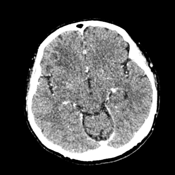 Cerebral ring enhancing lesions - cerebral metastases (Radiopaedia 44922-48818 B 122).jpg