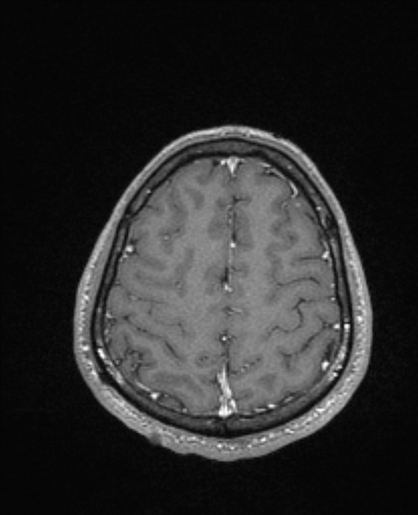 Cerebral toxoplasmosis (Radiopaedia 85779-101597 Axial T1 C+ 131).jpg