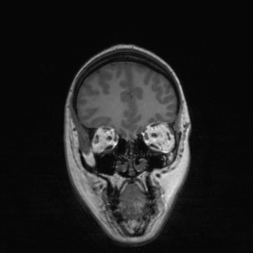 Cerebral tuberculosis with dural sinus invasion (Radiopaedia 60353-68090 Coronal T1 47).jpg