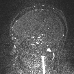 Cerebral tuberculosis with dural sinus invasion (Radiopaedia 60353-68090 Sagittal MRV 90).jpg