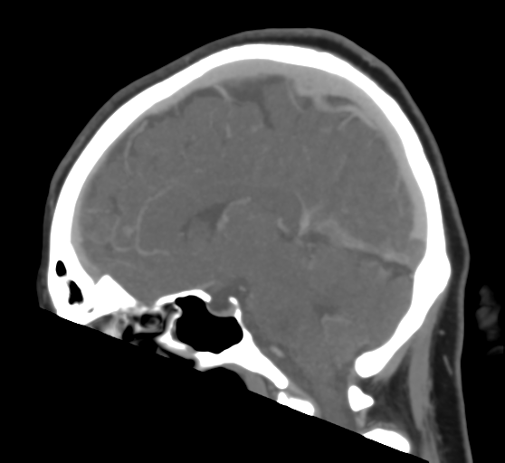 Cerebral venous infarction due to transverse sinus thrombosis (Radiopaedia 34688-36120 Sagittal CT venogram 27).png