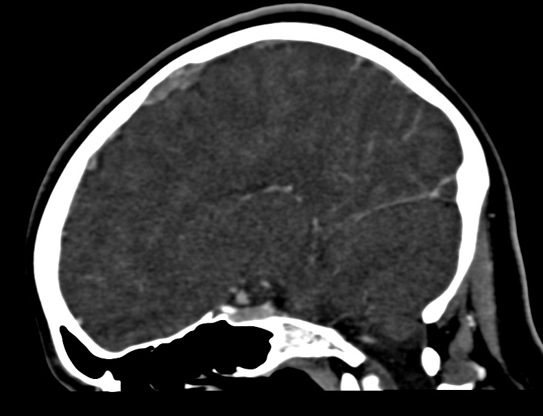 Cerebral venous sinus thrombosis (Radiopaedia 59224-66646 Sagittal C+ delayed 32).jpg