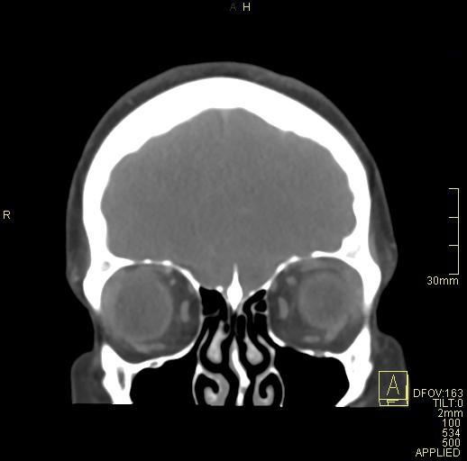 Cerebral venous sinus thrombosis (Radiopaedia 91329-108965 Coronal venogram 17).jpg