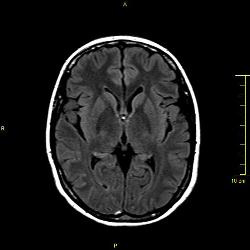 File:Cerebral venous thrombosis (Radiopaedia 23288-23351 Axial FLAIR 9).JPG