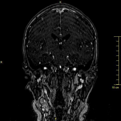 Cerebral venous thrombosis (Radiopaedia 23288-23351 MRV 80).JPG
