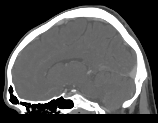 Cerebral venous thrombosis (Radiopaedia 38392-40467 D 30).png