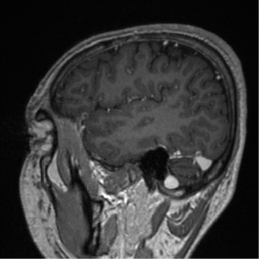 File:Cerebral venous thrombosis (Radiopaedia 38392-40469 Sagittal T1 C+ 22).png
