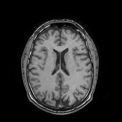 Cerebral venous thrombosis with secondary intracranial hypertension (Radiopaedia 89842-106957 Axial T1 109).jpg