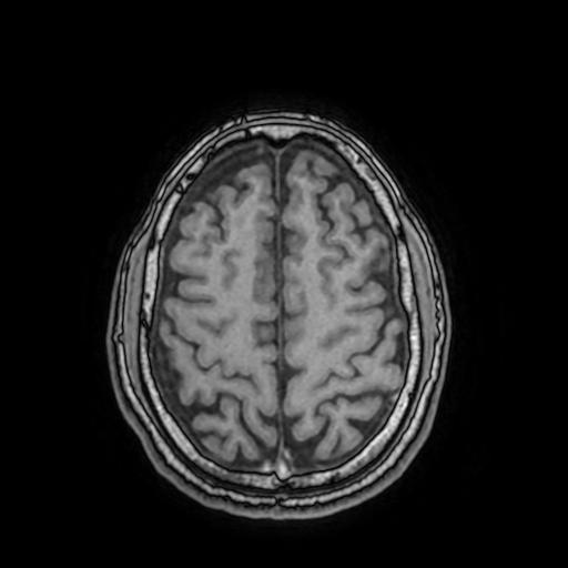 File:Cerebral venous thrombosis with secondary intracranial hypertension (Radiopaedia 89842-106957 Axial T1 132).jpg