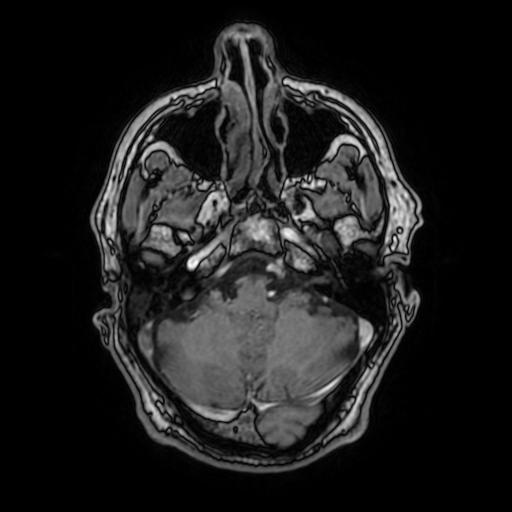 File:Cerebral venous thrombosis with secondary intracranial hypertension (Radiopaedia 89842-106957 Axial T1 C+ 53).jpg