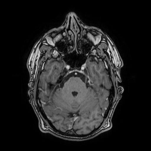 File:Cerebral venous thrombosis with secondary intracranial hypertension (Radiopaedia 89842-106957 Axial T1 C+ 64).jpg