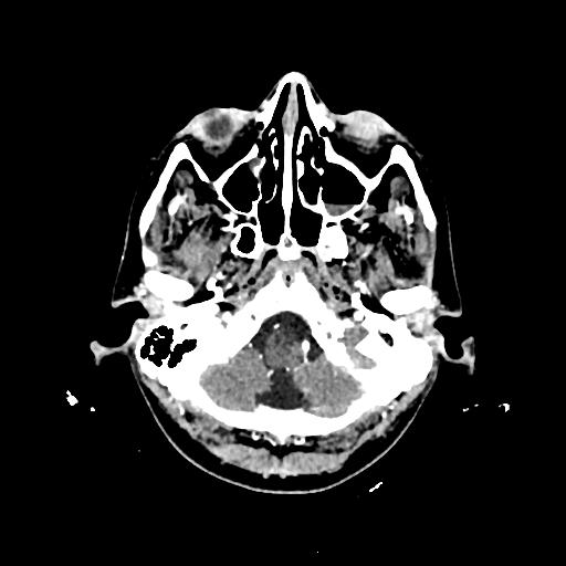 Cerebral venous thrombosis with venous hemorrhagic infarct (Radiopaedia 90354-107660 Axial with contrast 24).jpg