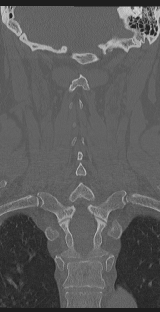 Cervical canal stenosis due to ossification of the posterior longitudinal ligament (Radiopaedia 47260-51823 Coronal bone window 43).png