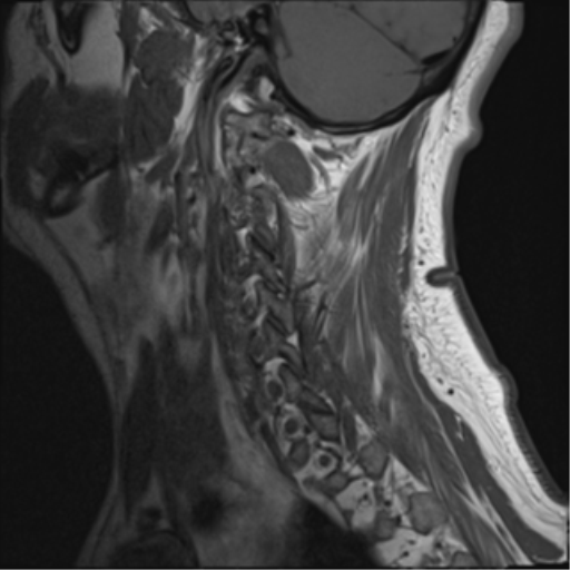 File:Cervical canal stenosis due to ossification of the posterior longitudinal ligament (Radiopaedia 47260-51824 Sagittal T1 15).png