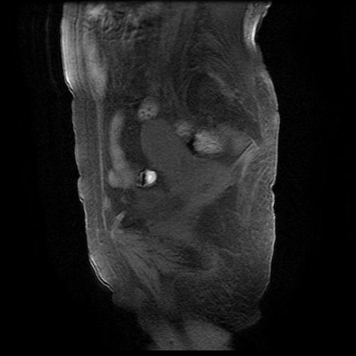 File:Cervical carcinoma (Radiopaedia 78847-91705 Sagittal T1 fat sat 5).jpg