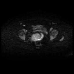 Cervical carcinoma (Radiopaedia 88010-104555 Axial DWI 49).jpg