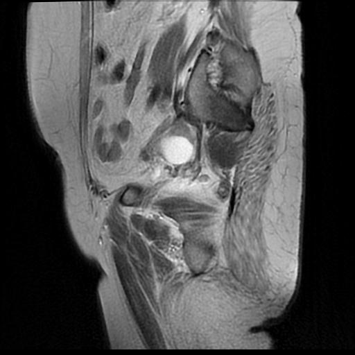 File:Cervical carcinoma (Radiopaedia 88010-104555 Sagittal T2 3).jpg