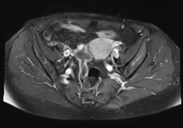 File:Cervical carcinoma (Radiopaedia 88312-104943 Axial T1 C+ fat sat 9).jpg